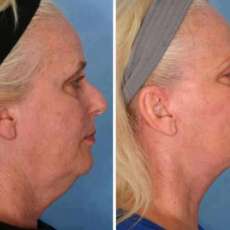 Wrapped Chin and Neck