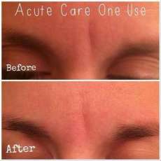 Acute care